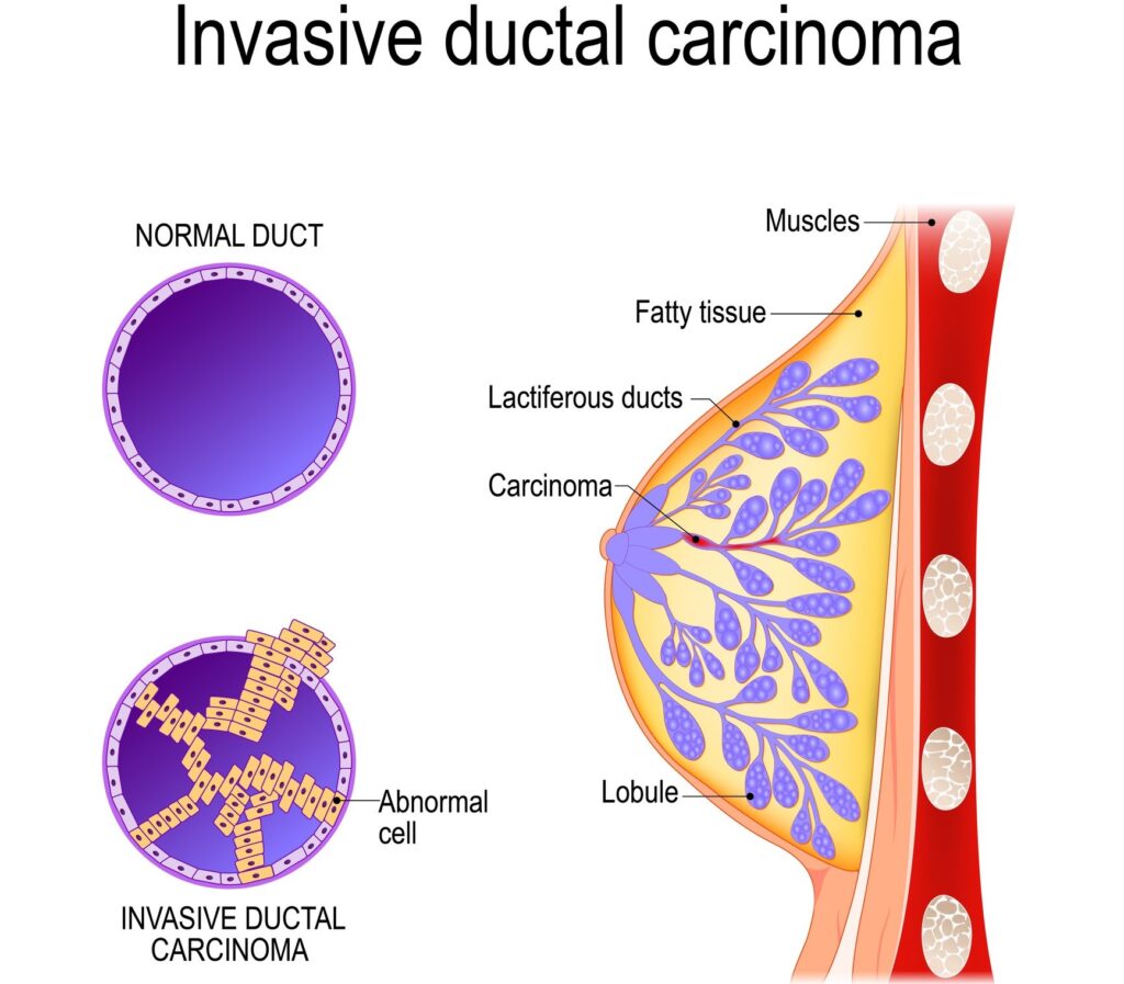 invasive_ductal_carcinoma