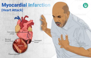Heart attack