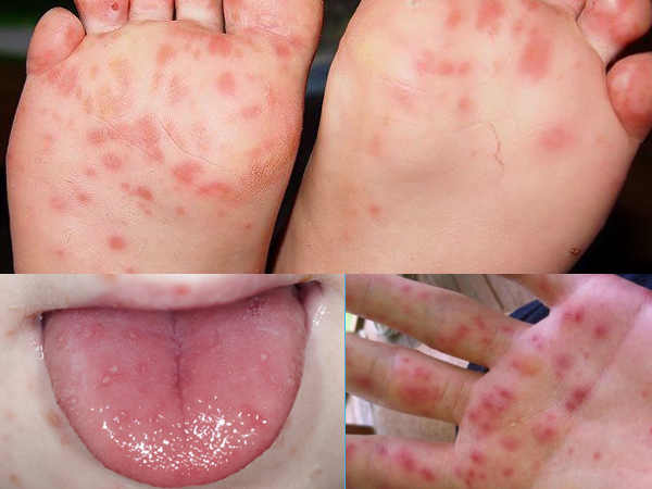 Hand Foot Mouth