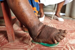 Filaria affected feet